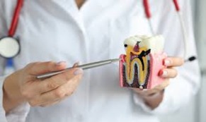 Root canal treatment