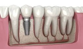 Dental Implants